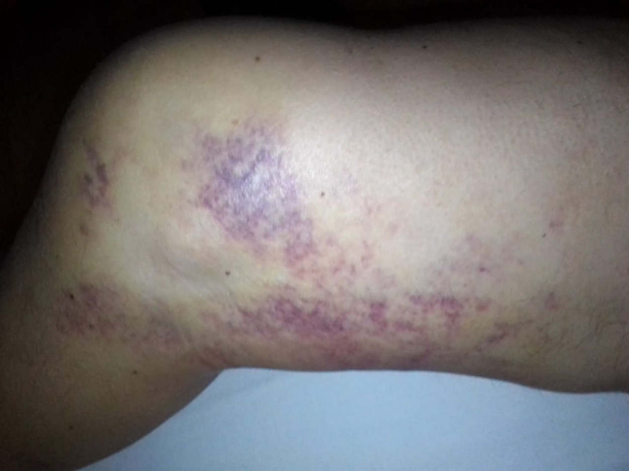 Нога Володимира після "горлівської прийомки".